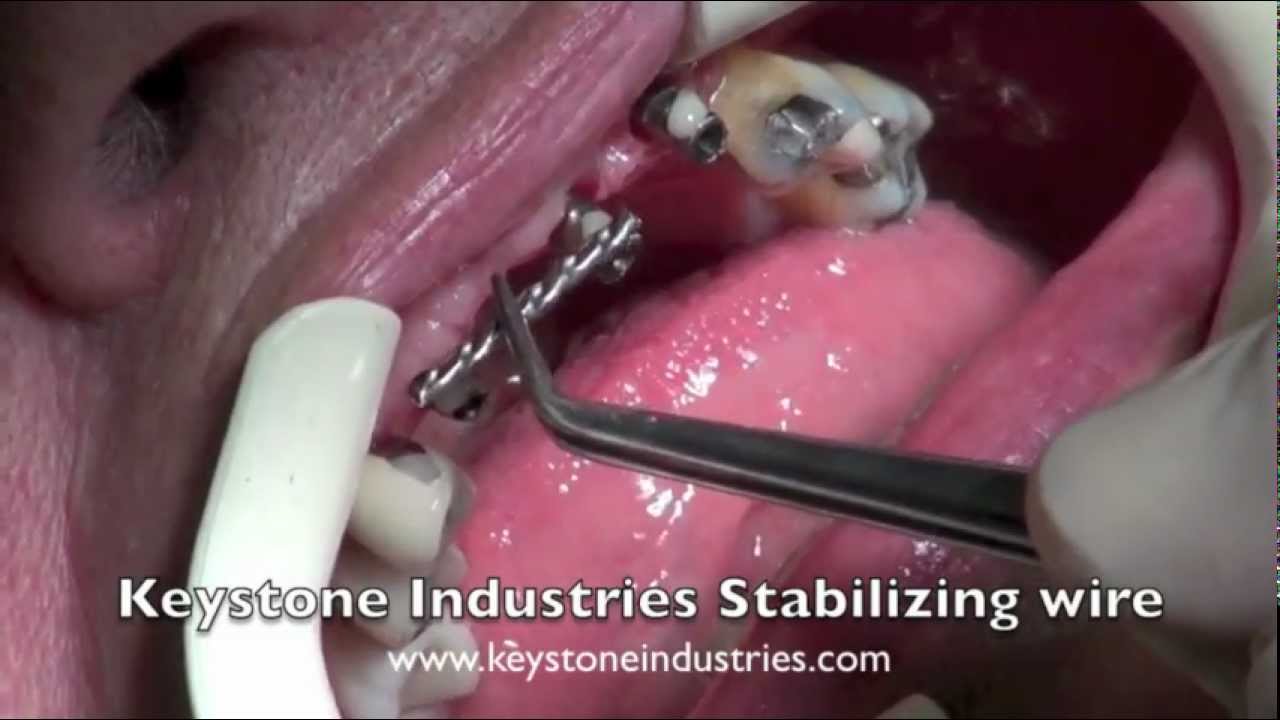 Dental Implant Bite Registration YouTube