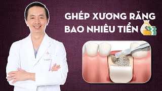 Ghép xương cấy implant | Khi nào nên thực hiện? | Nha khoa Elite