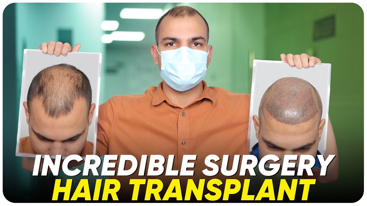 Hair Transplant in Jodhpur Best Results & Cost of Hair Transplant in
