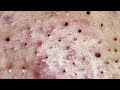 Relax Skincare Everyday with Acne Blackheads Treatment Spa #91012