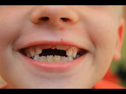 Удаление молочных зубов. Риски.  Телемедицина