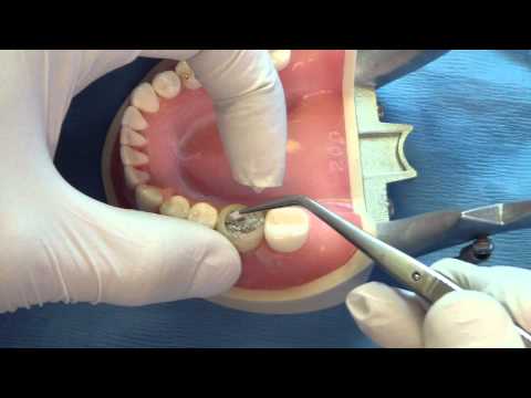 Amalgam Core Part 2