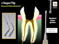 Integrated Endodontics Mi-EndoUltra Multi-Purpose Ultrasonic Endo Tips (Pack of 1) - 5