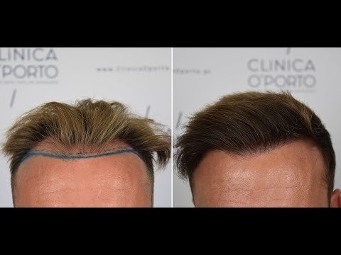dr-bruno-pinto---047---paciente-"ngls!"---2.545-grafts---injerto-capilar---clínica-oporto.