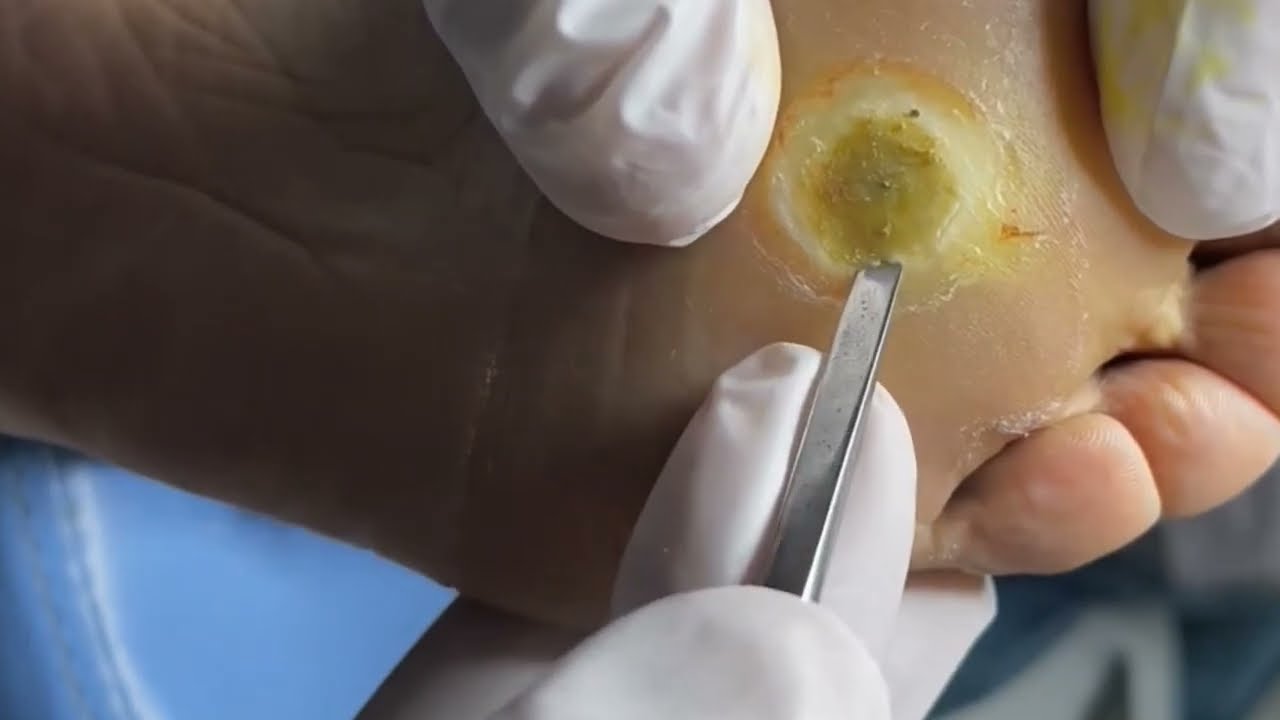 Treatment loan Nguyen corn feet YouTube