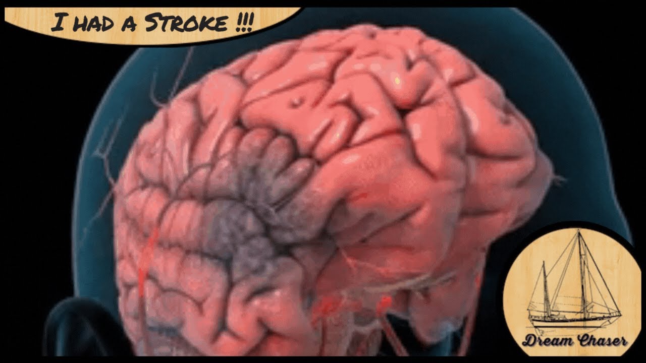 I had a STROKE - Learn from my mistakes!