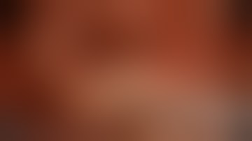 Laparoscopic Anterior Resection - English