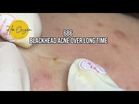 |686| Blackheads Acne over long time