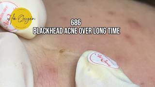 686 Blackheads Acne over long time