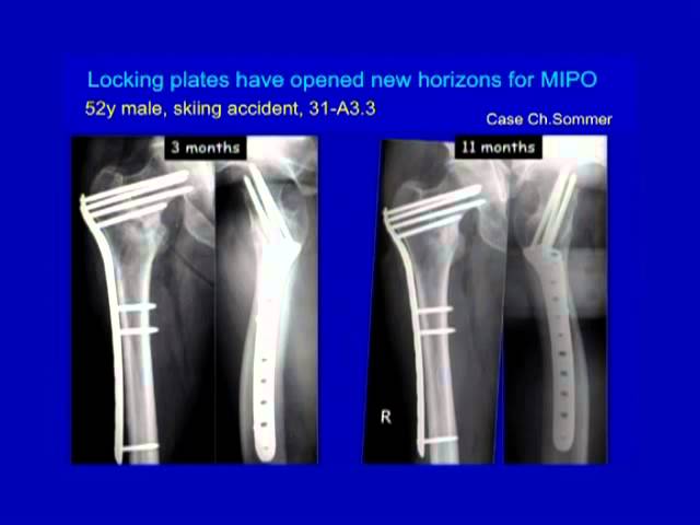 proximal femur fracture