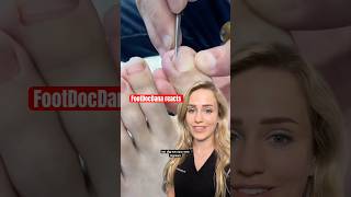 Doctor Reacts Removing An Ingrown Toenail