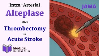Intra-Arterial Alteplase after Thrombectomy in Acute Stroke (PEARL) | JAMA | Med Journal Club
