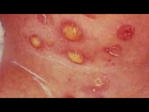 القوباء أسبابه طرق العدوى والعلاج 