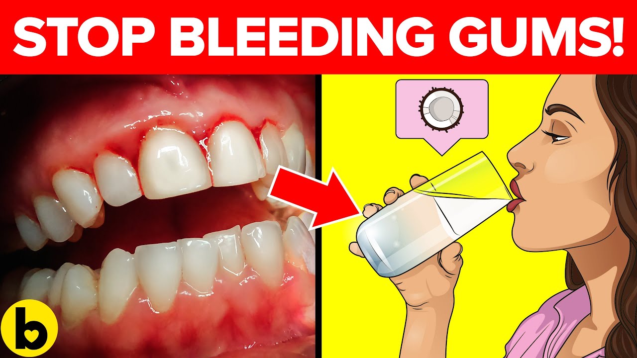 16 Great Techniques for Stopping Your Bleeding Gums YouTube