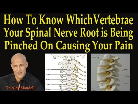 How to Know Which Vertebrae Your Spinal Nerve Root is Being Pinched On Causing Your Pain