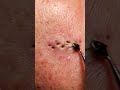 Blackhead Vacuum Suction Cleaning Every Pore (So Satisfying!)
