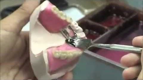 Framework Finish and Waxing for a Removable Partial Denture