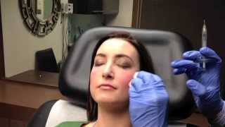 Juvederm Voluma Instant Cheek Augmentation In Chevy Chase, Md - Dr. Naderi