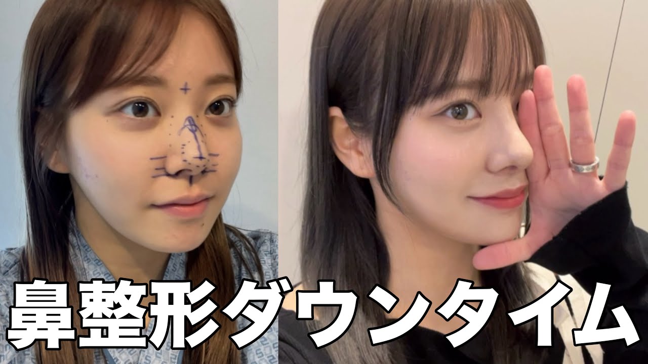 【裁断済】Rhinoplasty (鼻整形) I ジョン・ドンハク maxresdefault.jpg