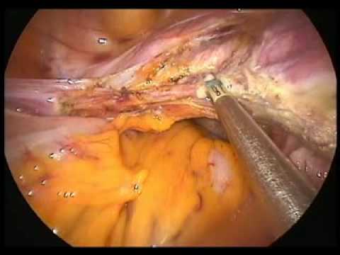 single port laparoscopic hysterectomy(sil...  prit...