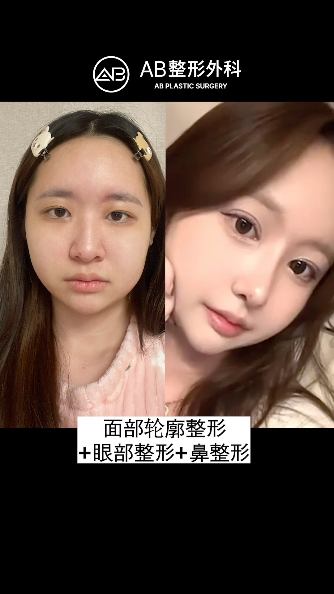 她整形後變超美, 醫生技術太神了吧! #shorts