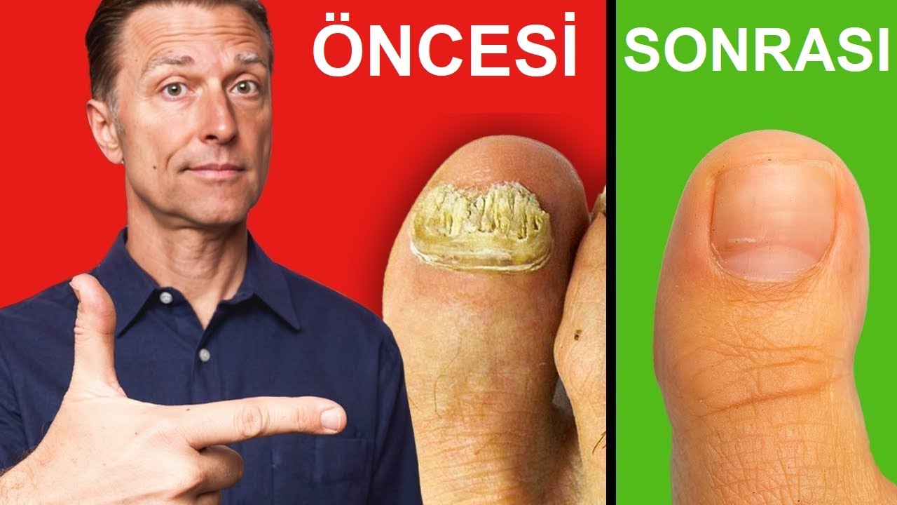 Tırnak Mantarından Kurtulmanın En Hızlı Yolu | Dr. Berg Türkçe