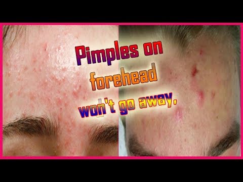 Pimples/Acne on Forehead Causes & Treatment
