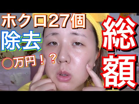 総額 ホクロ２７個除去から１週間経過 Youtube