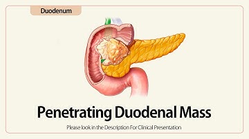 Linear EUS: Penetrating Duodenal Mass