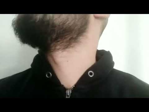 Patchy Beard 3 months growth (30 yo)