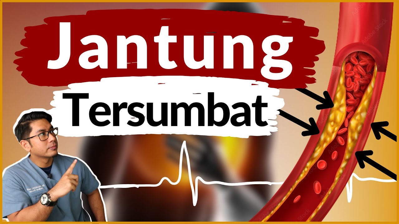 Jauhi 5 Makanan Menyebabkan Jantung Tersumbat dengan Kolestrol | Doctor Sani |