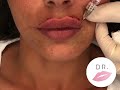 Filler Labbra by Dr. Pierluigi Gigliofiorito for Dr. Lips