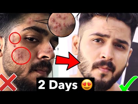 10 Biggest Pimple Mistakes | Tips Remove Pimple, Acne Fast | Remove Pimple Naturally from Face