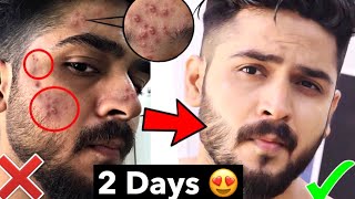 10 Biggest Pimple Mistakes | Tips Remove Pimple, Acne Fast | Remove Pimple Naturally from Face