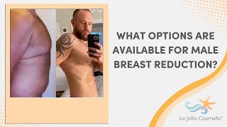 What options are available for male breast reduction?
