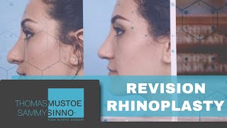 TLKM Plastic Surgery: Revision Rhinoplasty