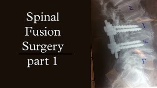 Spinal Fusion Surgery | pt.1