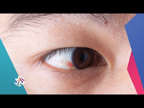فيديو: ماذا تفعل إذا كان الطفل مصابًا بالعين الحمراء