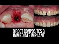 Direct composites  immediate implant