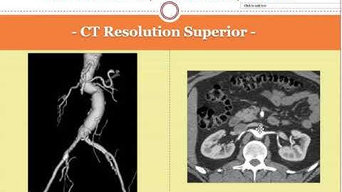 What is a CTA or CT angiogram?