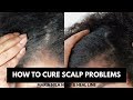 HOW TO CURE SCALP PROBLEMS WITH MARIA NILA HEAD & HEAL LINE