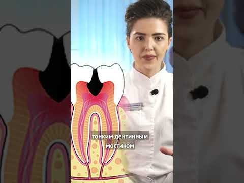 Что такое глубокий #кариес?