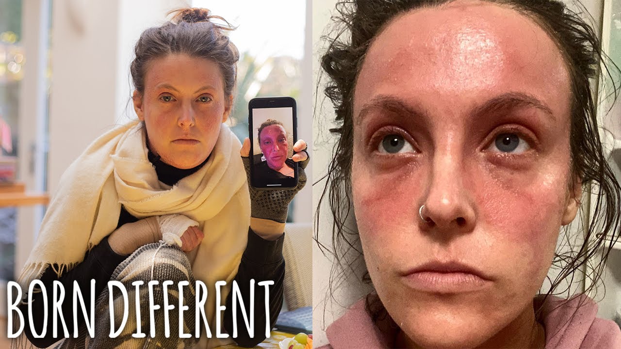 My Eczema Is So Bad I Was Offered Cancer Treatment | BORN DIFFERENT