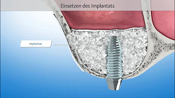 Wie schlimm ist ein Sinuslift?