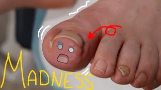 Escape the Pain: Watch This Satisfying Ingrown Nail Removal