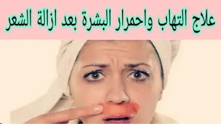 طريقة فعالة لعلاج حروق. إلتهاب وتهيج و احمرار البشرة بعد إزالة الشعر في 5 دقائق مجربة.