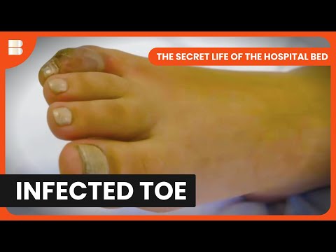 Infected Toe Red Line Spreads Up Foot In A&E