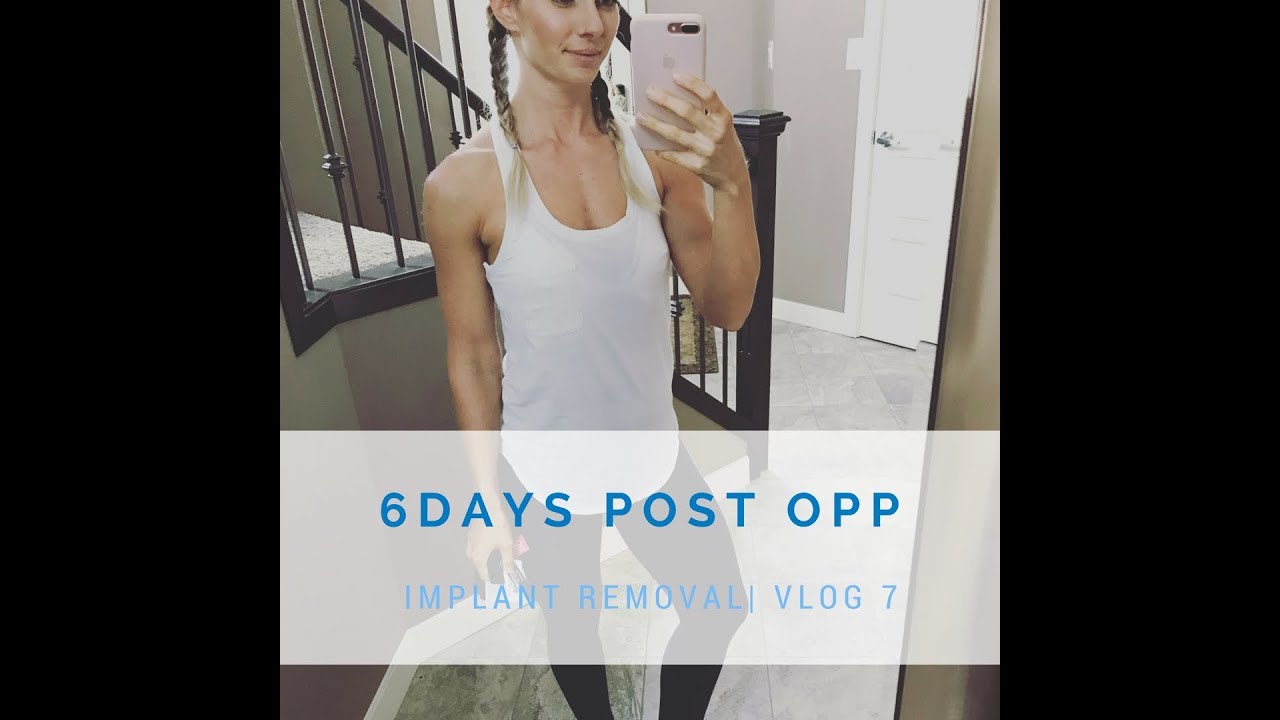 6 days post breast implant removal/ How i'm feeling YouTube