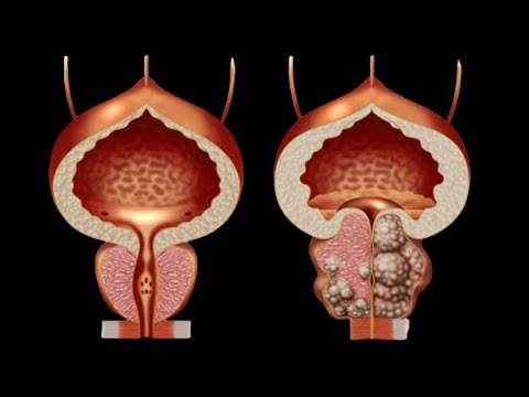 Halten Sie Ihre Blase und Prostata gesund! Großvater ist 90 und fühlt sich wie 30!