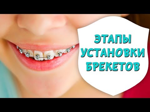 Этапы установки брекетов. Установка металлических брекетов | Доктор Д | Дентал ТВ Этапы установки брекетов. Установка металлических брекетов | Доктор Д | Дентал ТВ